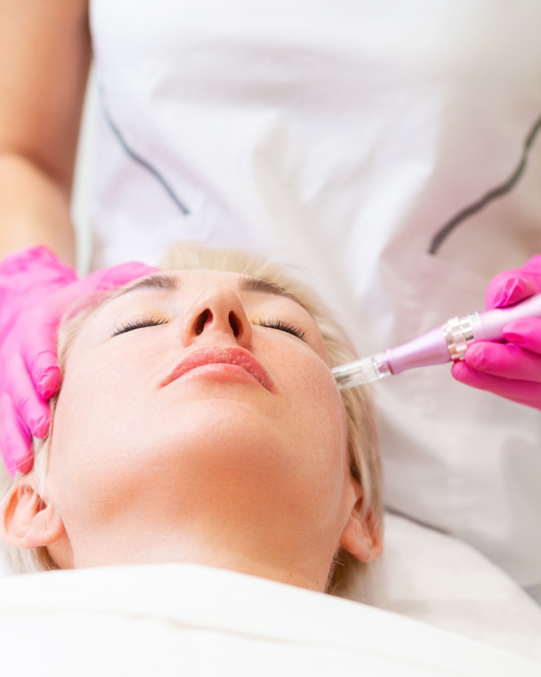 MICRONEEDLING